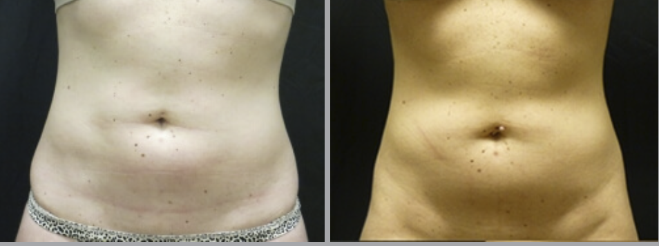 Liposuction in Ventura, CA